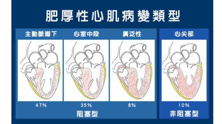 肥厚性心肌病變類型 肥厚性心肌病變類型