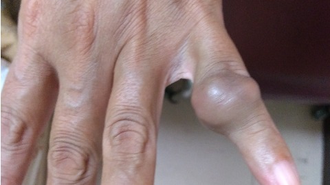 手指腱鞘巨細胞瘤