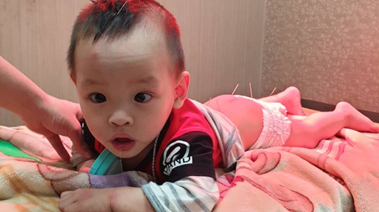 小兒腦性麻痺 小兒腦性麻痺