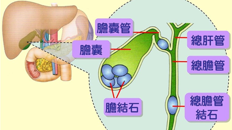 膽結石 膽結石