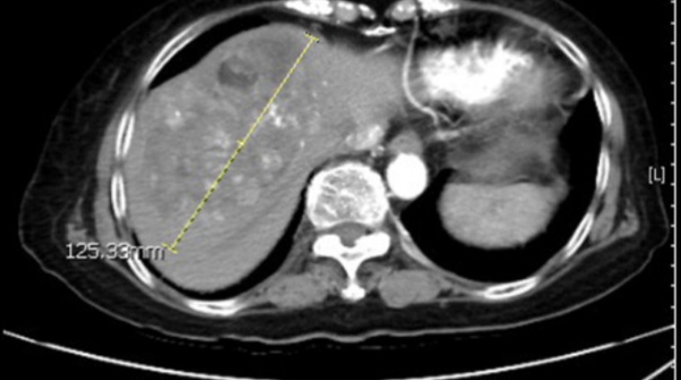 12公分肝腫瘤之電腦斷層影像