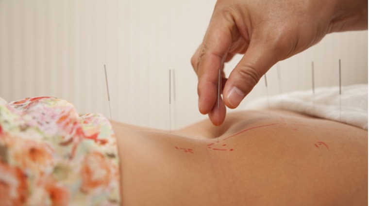 針灸