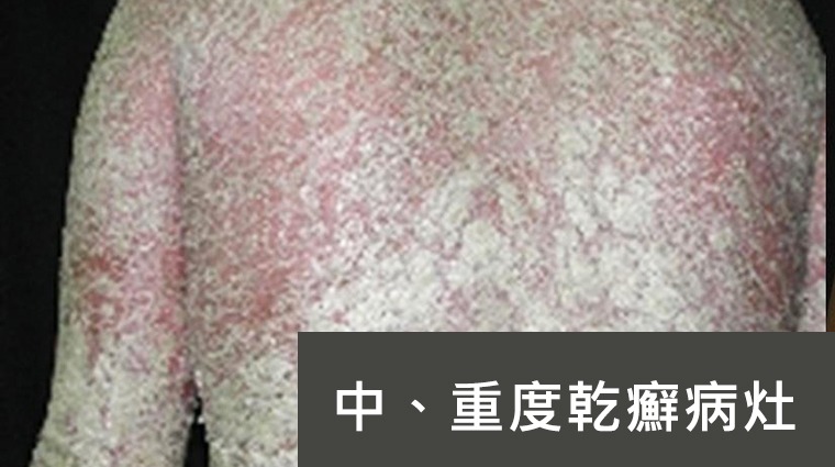 中、重度乾癬病灶 中、重度乾癬病灶