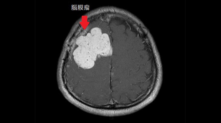 核磁共振檢查腦膜瘤