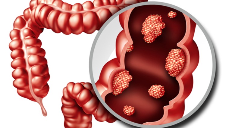 大腸癌細胞 大腸癌細胞