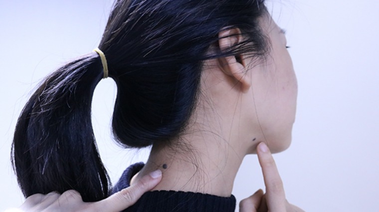 痣 痣