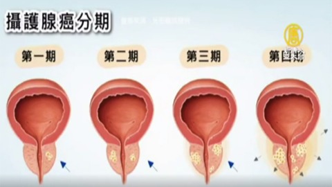 攝護腺癌分期