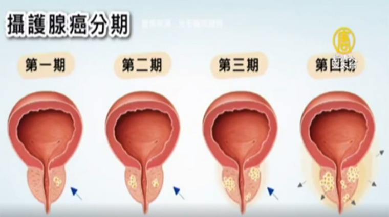 攝護腺癌分期 攝護腺癌分期