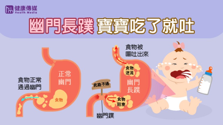 幽門長蹼示意圖 幽門長蹼示意圖