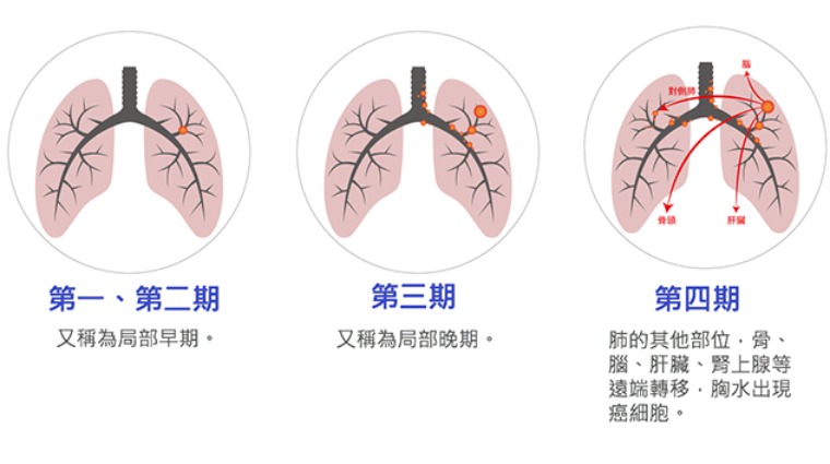 肺癌分期 肺癌分期