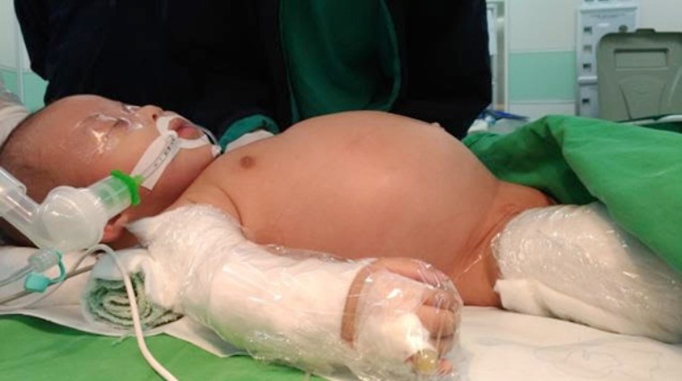 男嬰腹部腫脹 男嬰腹部腫脹