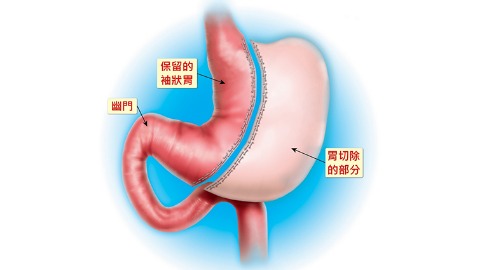 胃袖狀切除手術