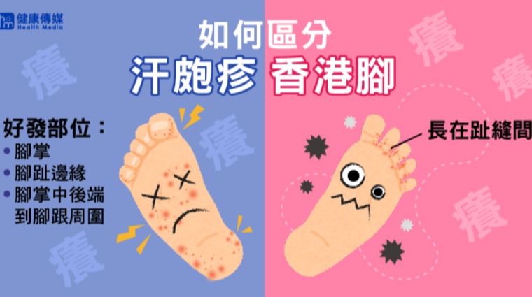 汗皰疹 汗皰疹