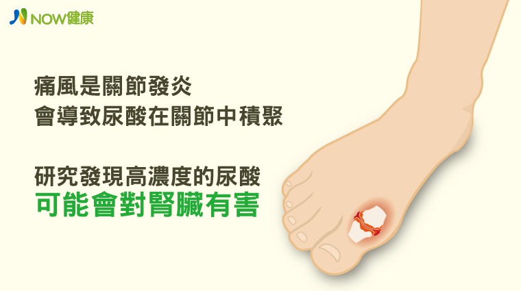 痛風恐列入慢性腎病危險因子 痛風恐列入慢性腎病危險因子