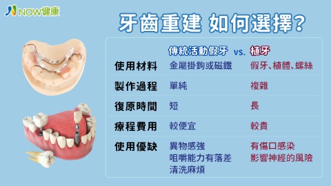 傳統活動假牙與植牙比較