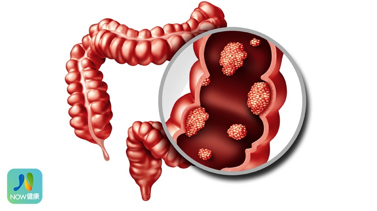 大腸癌 大腸癌