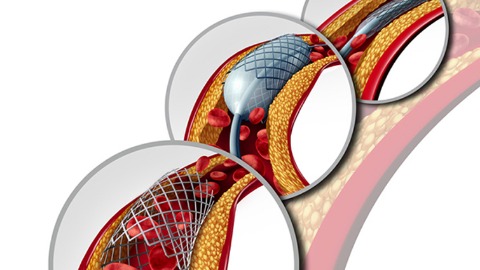 冠狀動脈血管支架治療