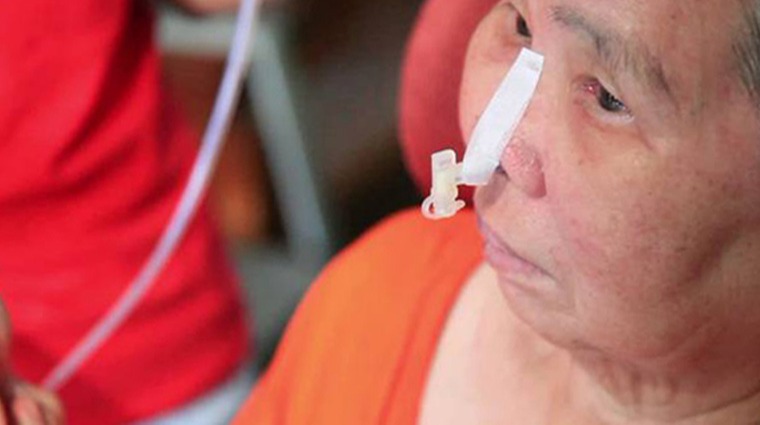 兩截式鼻胃管 兩截式鼻胃管