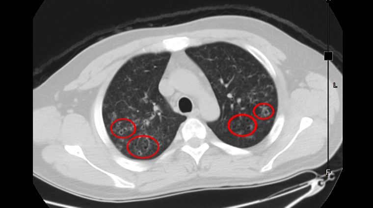 瀰漫性空腔囊腫 瀰漫性空腔囊腫