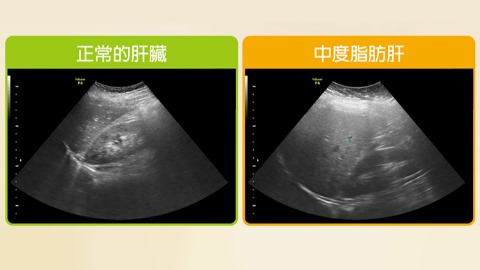 上腹部超音波