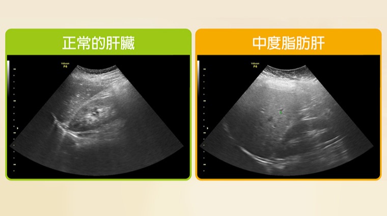 上腹部超音波 上腹部超音波