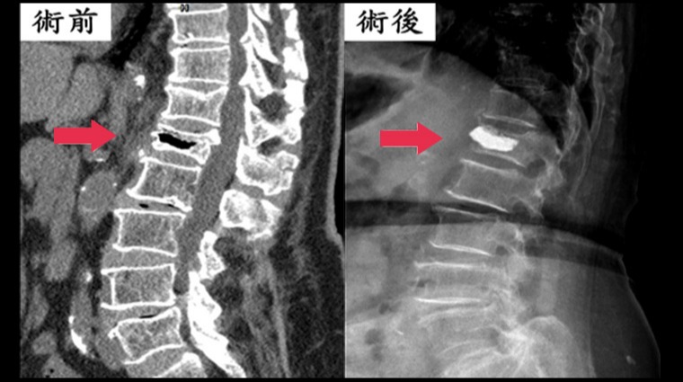壓迫性骨 壓迫性骨