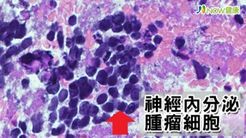 切片顯示為神經內分泌腫瘤細胞（紅色箭頭處）