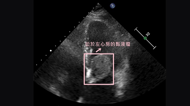 心臟腫瘤 心臟腫瘤