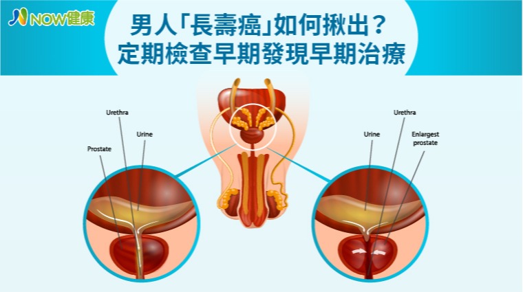 攝護腺 攝護腺
