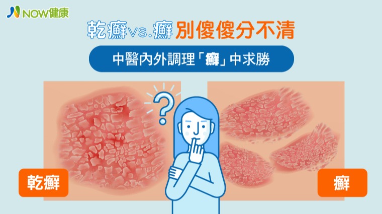 乾癬與癬的差異 乾癬與癬的差異