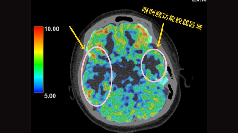 癲癇 癲癇