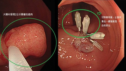大腸鏡