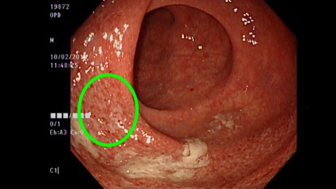 潰瘍性結腸炎