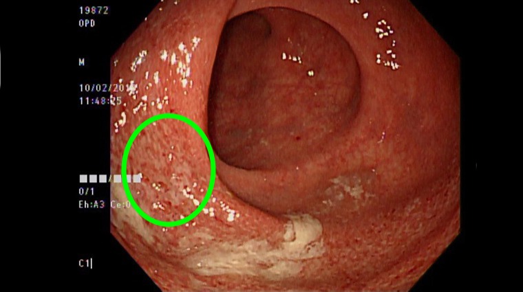 潰瘍性結腸炎 潰瘍性結腸炎