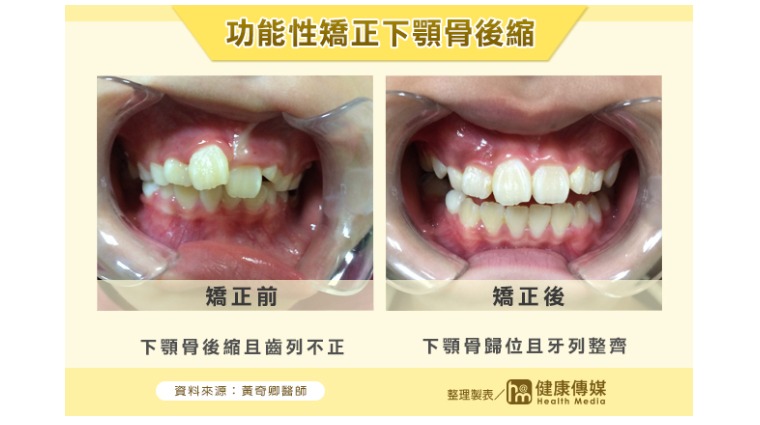 功能性矯正 功能性矯正