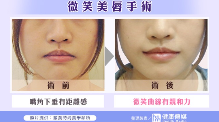 微笑美唇手術 微笑美唇手術