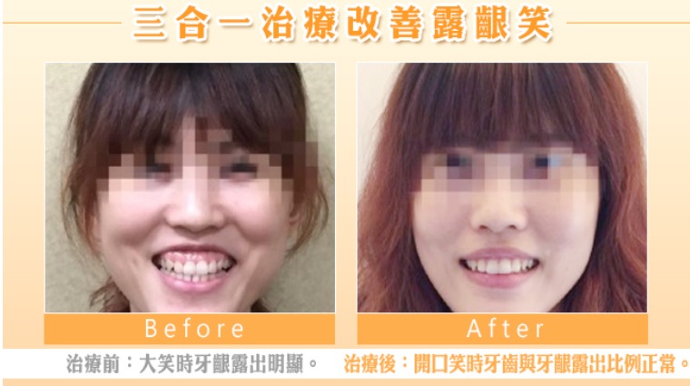 三合一治療改善露齦笑 三合一治療改善露齦笑
