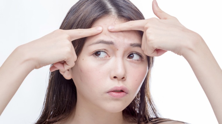抗痘中藥材 抗痘中藥材