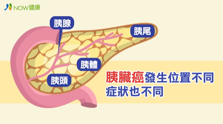 胰臟癌 胰臟癌