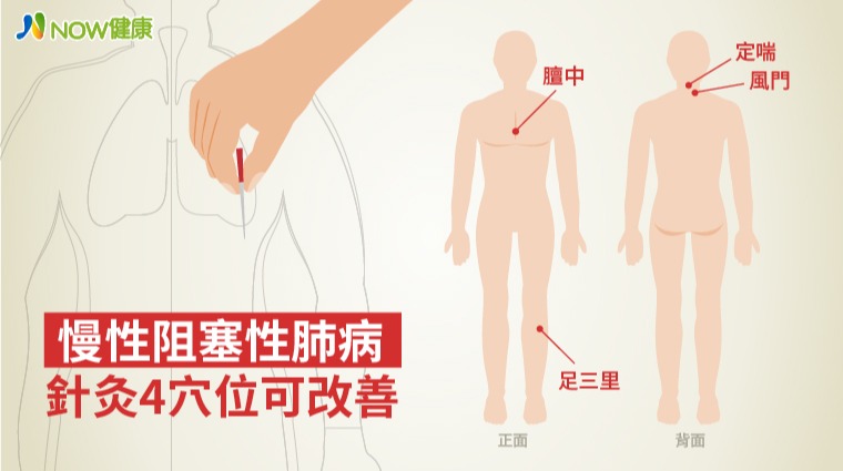 慢性阻塞性肺病 針灸4穴位可改善 慢性阻塞性肺病 針灸4穴位可改善