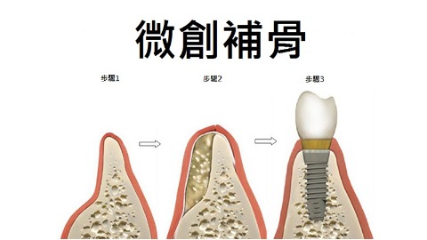 微創補骨