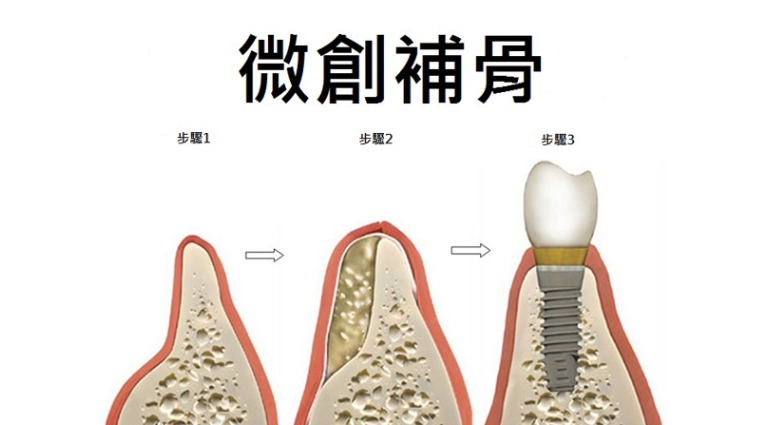 微創補骨 微創補骨