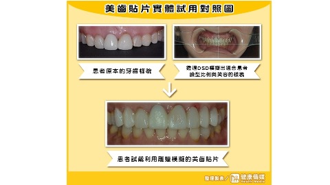 美齒貼片實體試用對照圖