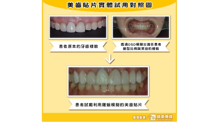 美齒貼片實體試用對照圖 美齒貼片實體試用對照圖