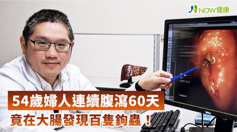 54歲婦人連續腹瀉60天竟在大腸發現鉤蟲! 54歲婦人連續腹瀉60天竟在大腸發現鉤蟲!