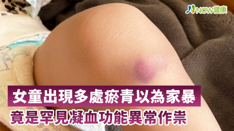 女童出現多處瘀青以為家暴 竟是罕見凝血功能異常作祟 女童出現多處瘀青以為家暴 竟是罕見凝血功能異常作祟