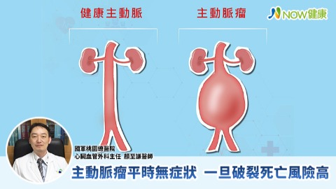 主動脈瘤平時無症狀 一旦破裂死亡風險高