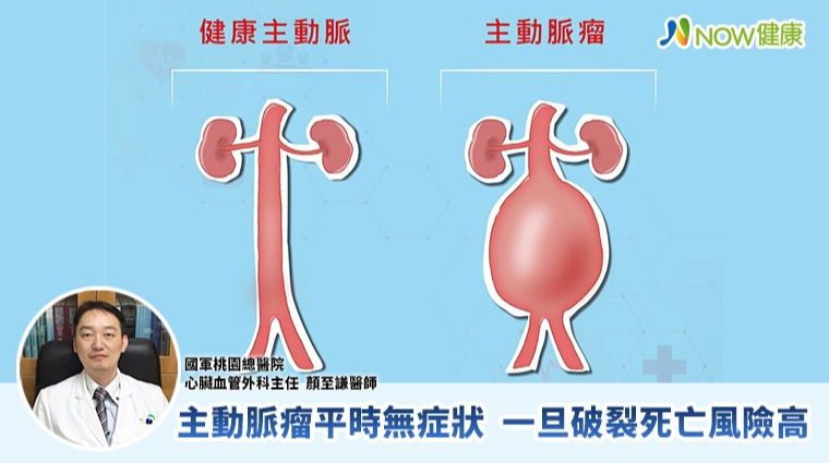 主動脈瘤平時無症狀 一旦破裂死亡風險高