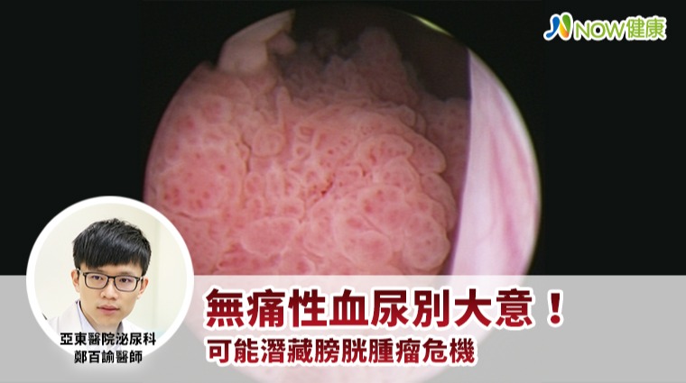 無痛性血尿別大意! 可能潛藏膀胱腫瘤危機 無痛性血尿別大意! 可能潛藏膀胱腫瘤危機