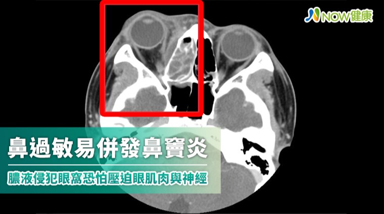 鼻過敏易併發鼻竇炎 膿液侵犯眼窩恐怕壓迫眼肌肉與神經 鼻過敏易併發鼻竇炎 膿液侵犯眼窩恐怕壓迫眼肌肉與神經